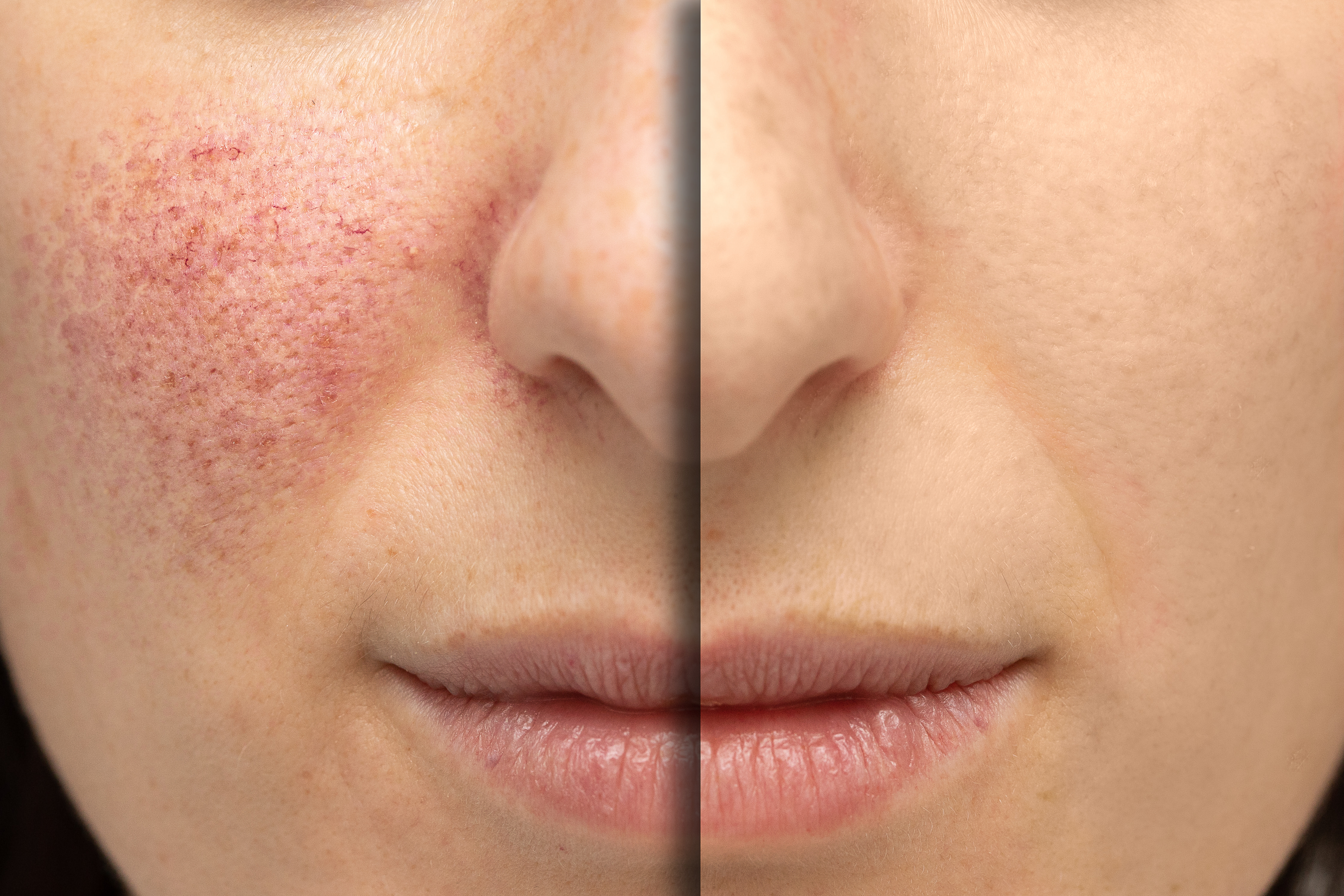 Side view of Intense Pulsed Light treatment
